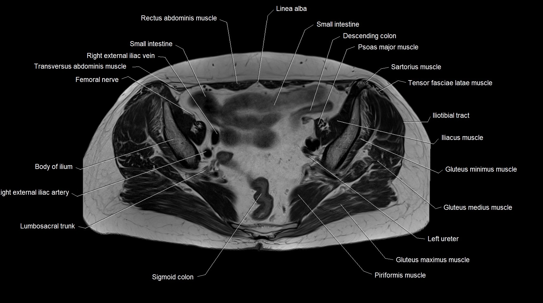 MRI 3T pelvis axial cross section anatomy image 15.webp